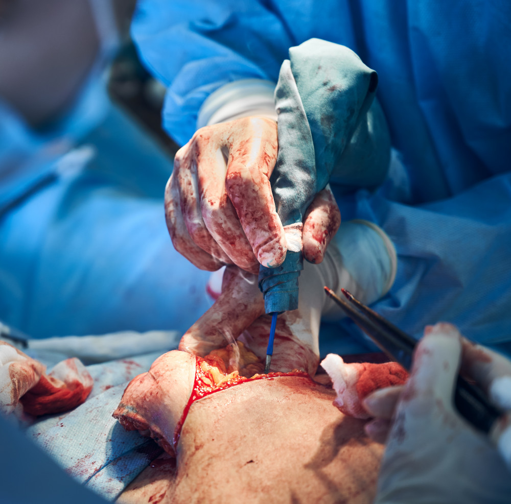 Abdominoplastie : quand faut-il franchir le pas ?